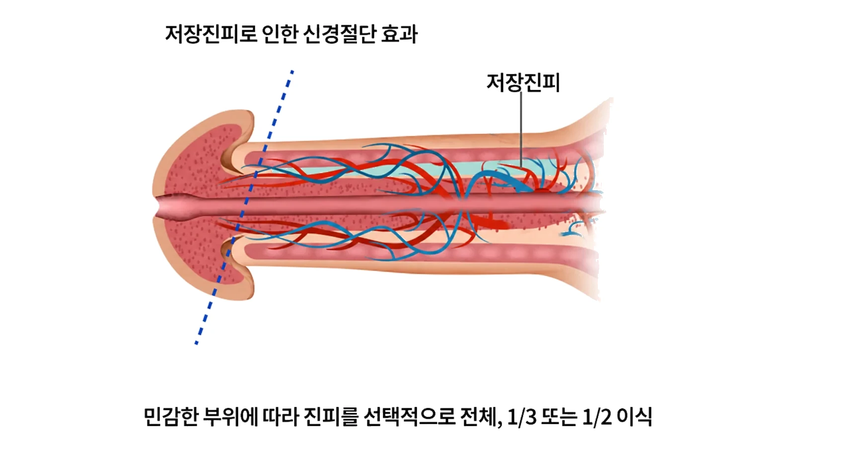선택적 신경차단술과 미세신경완화 조루수술의 처리 범위 비교