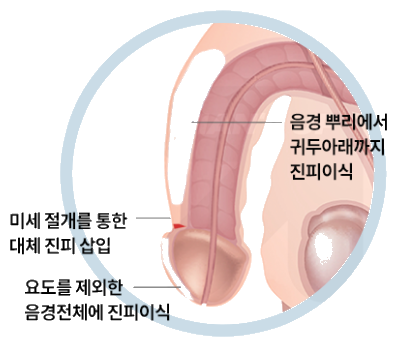 미세절개 위치와 이식 범위