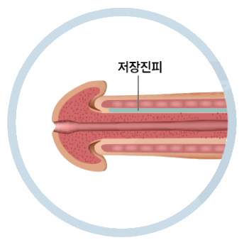 저장진피주사 귀두확대술의 진행 순서