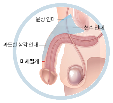 미세절개와 치골 부위 절개의 접근 경로