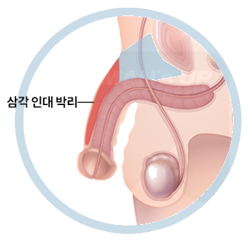 인대의 위치와 박리 범위