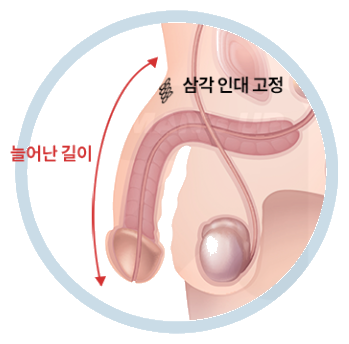 미세절개 길이연장술의 진행 순서