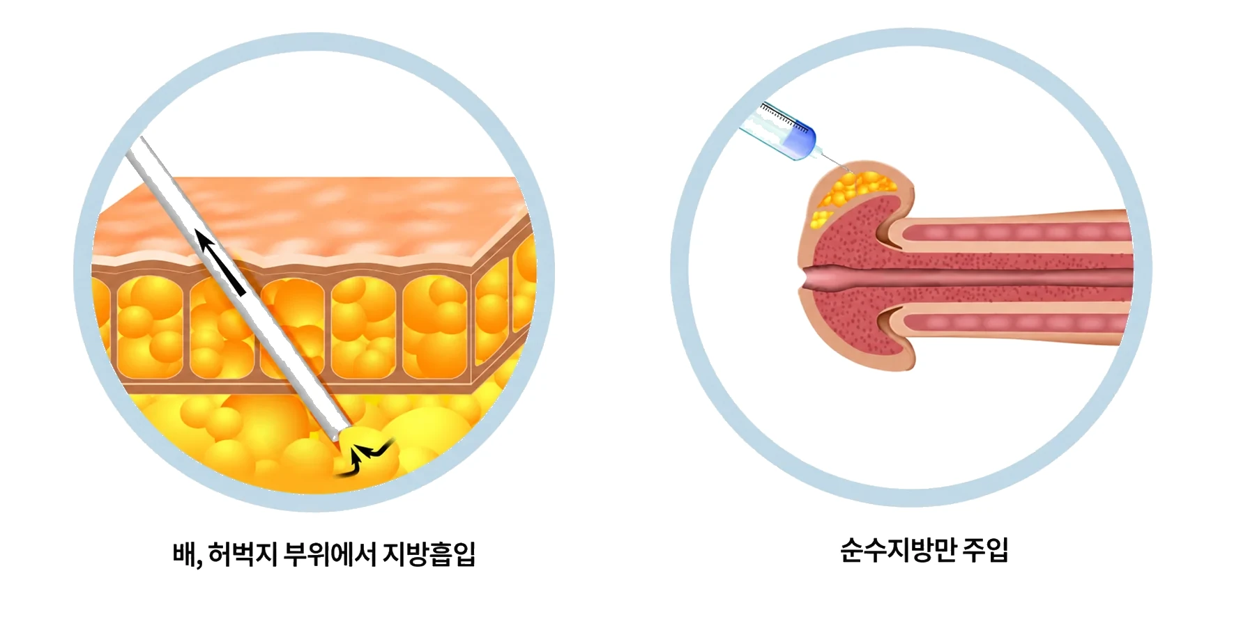 자가지방 채취와 귀두 부위의 주입 위치를 보여주는 설명 그림