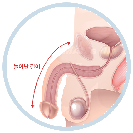 하복부 및 치골부 지방흡입술의 진행 순서
