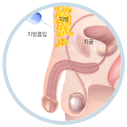 하복부 및 치골부 지방흡입술의 진행 순서
