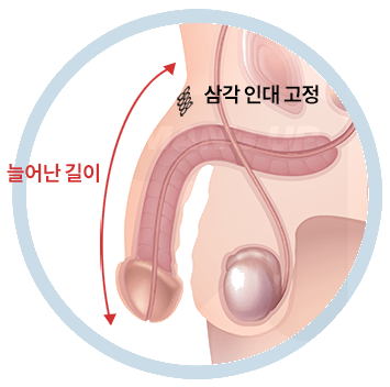 미세절개를 이용한 길이 연장술의 진행 순서