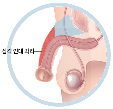 음경해면체를 잡아당기는 인대를 구분해 박리 범위를 정합니다