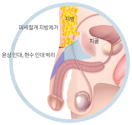 미세절개와 치골 부위 절개의 접근 경로