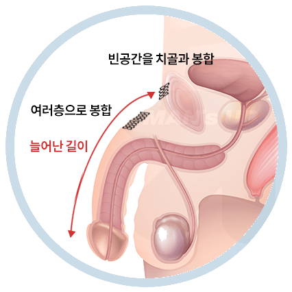 치골부절개를 이용한 길이연장술의 진행 순서
