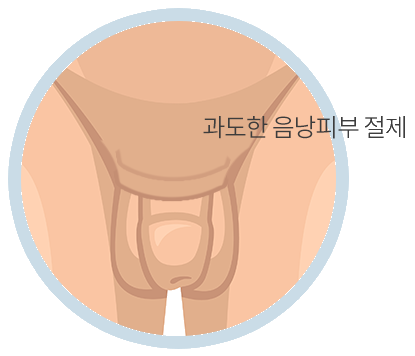 음낭피부 성형술 전후의 형태 비교