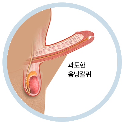 음낭갈퀴성형술 전후의 형태 비교