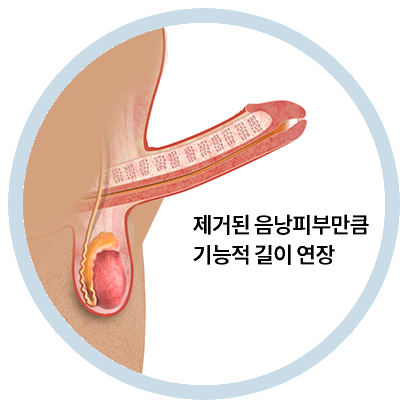 음낭갈퀴성형술 전후의 형태 비교