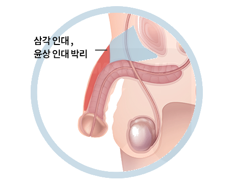 오감만족 복합수술에 포함되는 처치