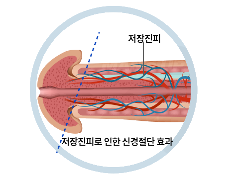 오감만족 복합수술에 포함되는 처치
