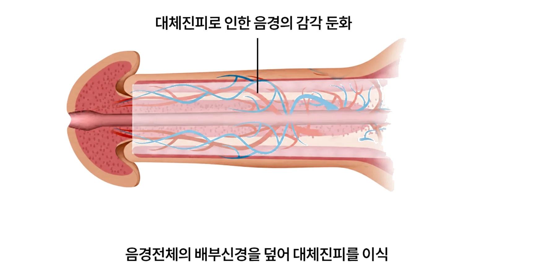 음경둔화술에서 진피를 덮는 범위