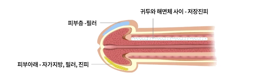 귀두의 단면과 재료 적용 부위