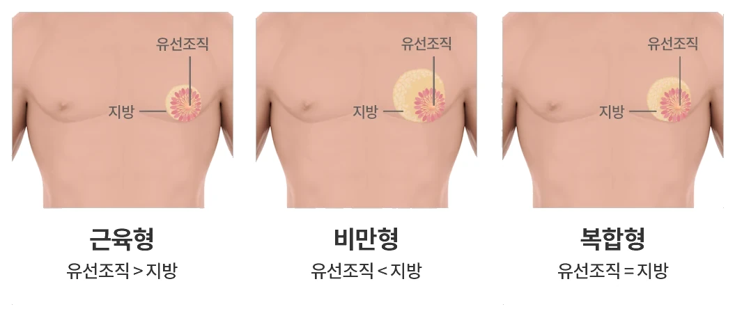 가슴의 유선조직과 지방을 표시하고 세 가지 조직 구성 유형을 비교한 여유증 설명 그림