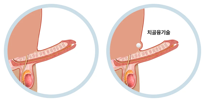 치골융기술 전후 비교 — 치골 위에 넣은 보형물로 음경 뿌리가 드러나 보이는 모습