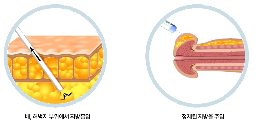 자가지방 귀두확대술의 진행 순서