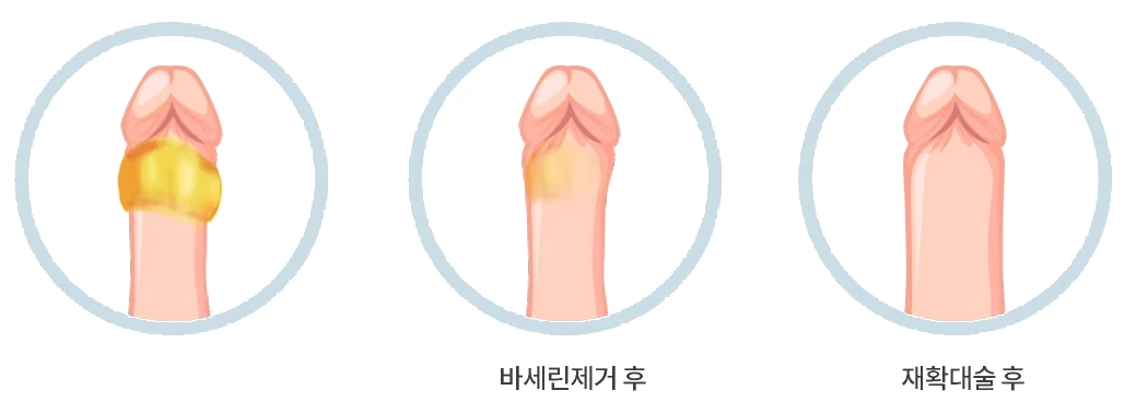 바세린 제거와 재확대의 진행 순서