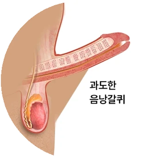 음낭 피부가 음경 아래쪽으로 물갈퀴처럼 높게 이어진 음낭갈퀴 상태