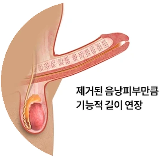 음낭갈퀴 교정 뒤 음경 아래쪽이 드러난 상태