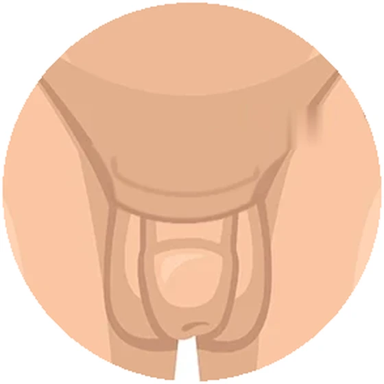 정면에서 본 음경과 음낭 사이의 이어진 피부와 절제 계획 범위