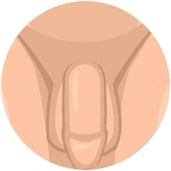 여분의 음낭 피부를 절제하고 음경과 음낭 경계에 맞춰 봉합한 모습