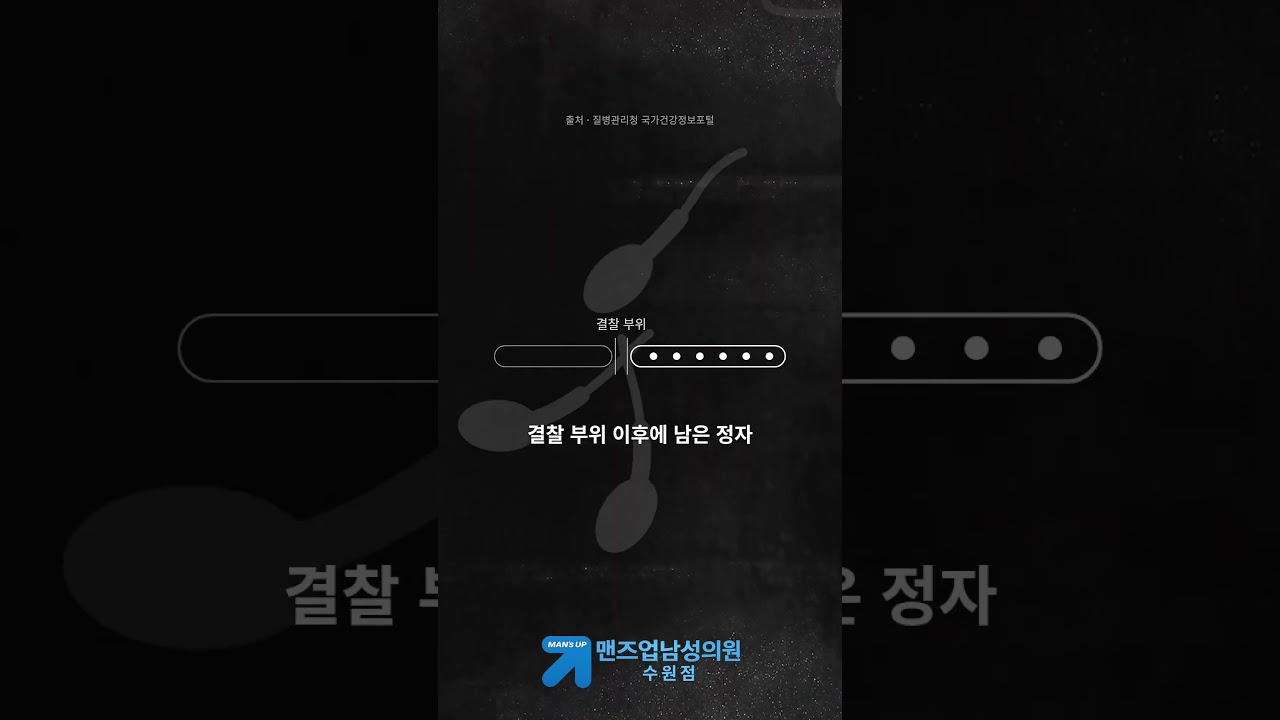 정관수술도 토요일에 되나요? 피임 시작 시점은 언제부터